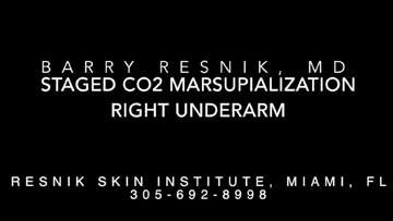 Staged CO2 Marsupialization Right Underarm