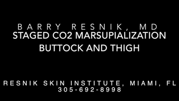 Staged CO2 Marsupialization Buttock and Thigh